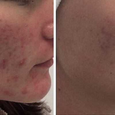 Microdermabrasion-Before-and-After-3