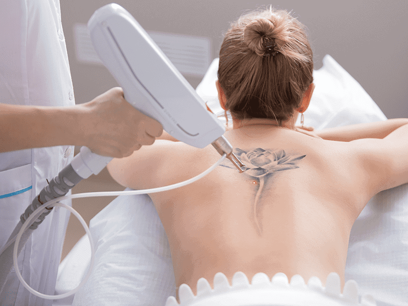 laser-tattoo-removal